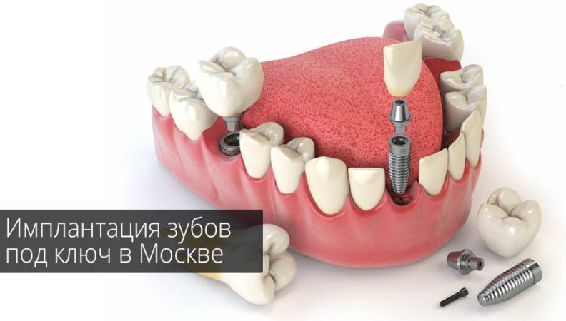 Имплантация зубов в Москве