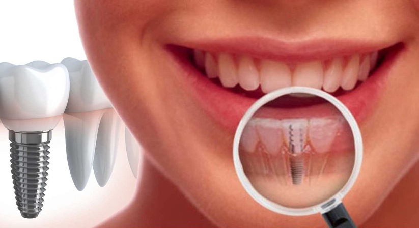 Качественные импланты зубов