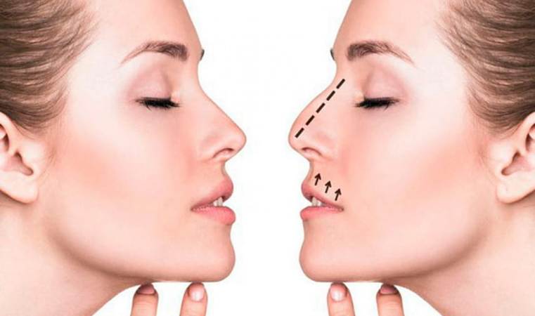 Ринопластика - изменение внешнего вида носа